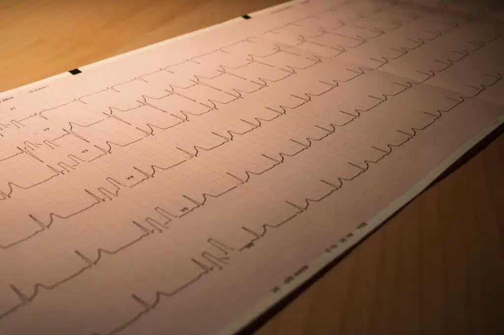 abnormal ekg